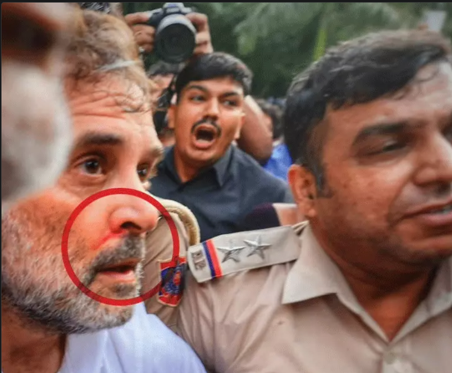 "21 जुलाई को जब पुलिस ने हमें हिरासत में लिया, तो धक्का-मुक्की में मुझे चोट लगी और मुंह से खून आया।
